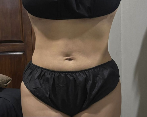 Antes